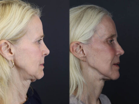 Facelift case #7418