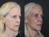 Facelift case #7418 slider thumbnail