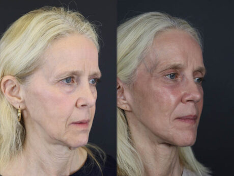Facelift case #7418