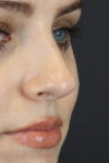 Rhinoplasty case #7390