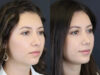 Rhinoplasty case #7324 slider thumbnail