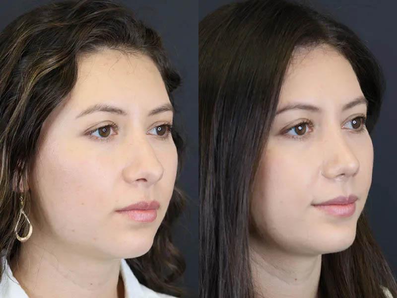 Rhinoplasty case #7324