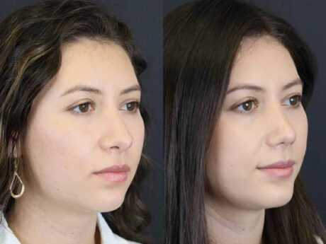 Rhinoplasty case #7324