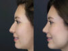 Rhinoplasty case #7324 slider thumbnail
