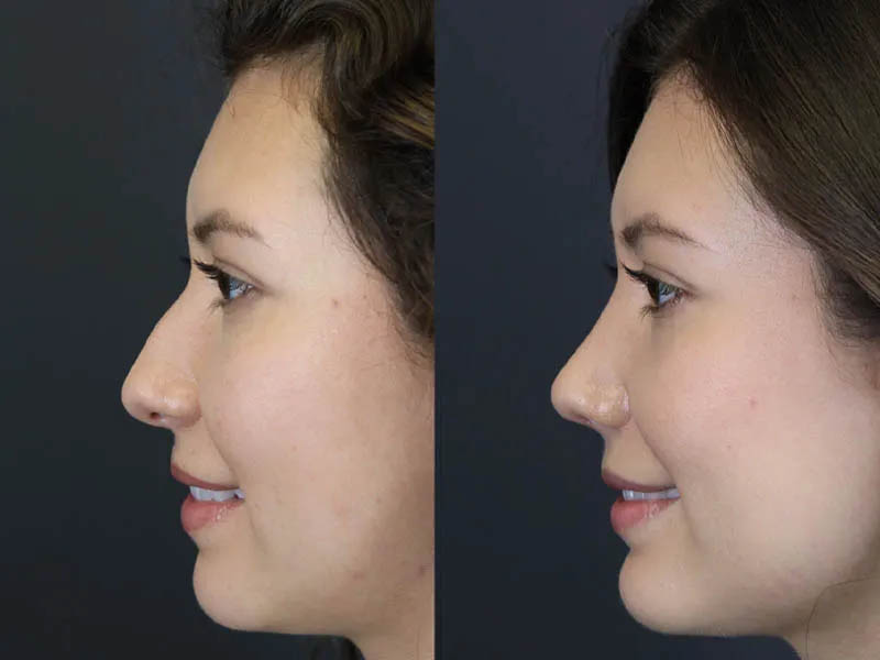 Rhinoplasty case #7324
