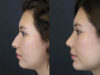 Rhinoplasty case #7324 slider thumbnail