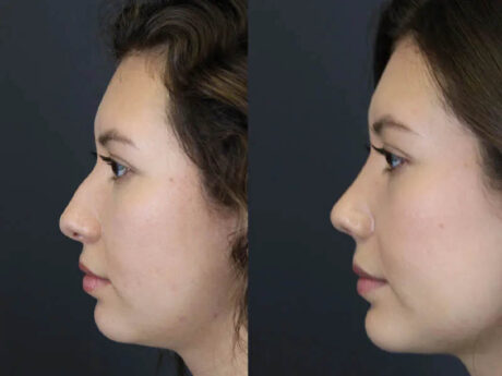Rhinoplasty case #7324