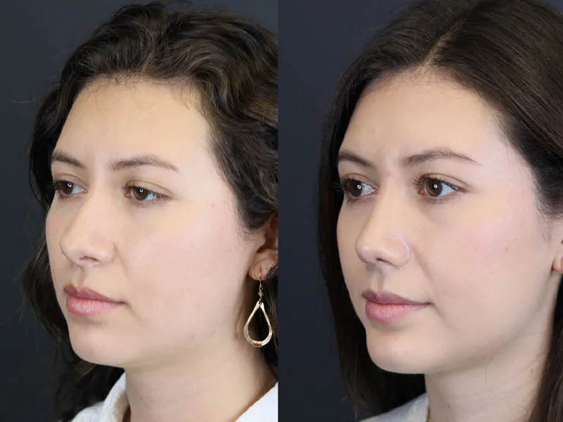 Rhinoplasty case #7324