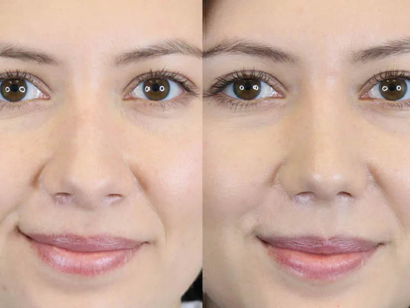 Rhinoplasty case #7324