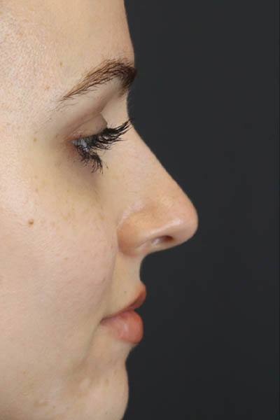 Rhinoplasty case #7390