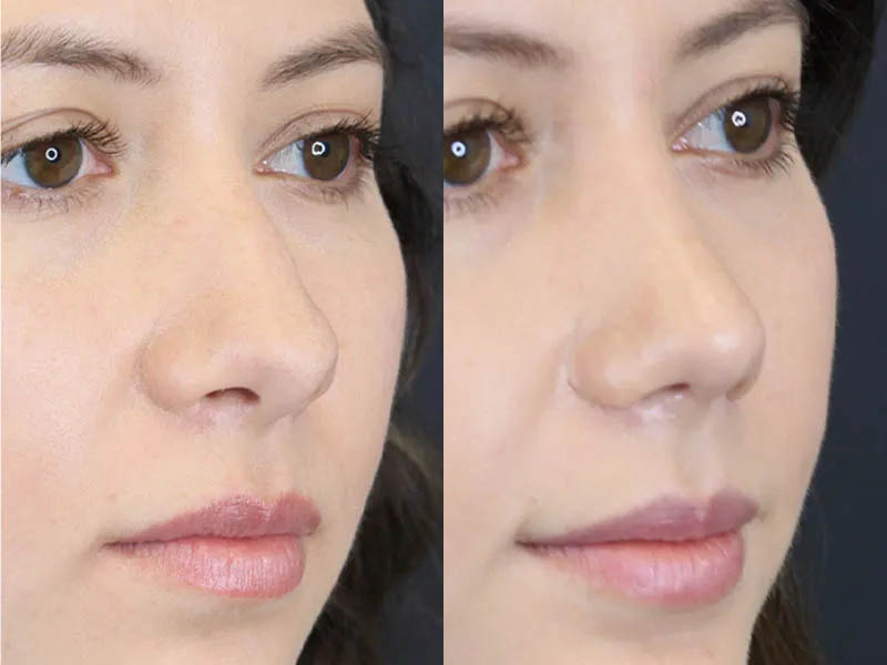 Rhinoplasty case #7324