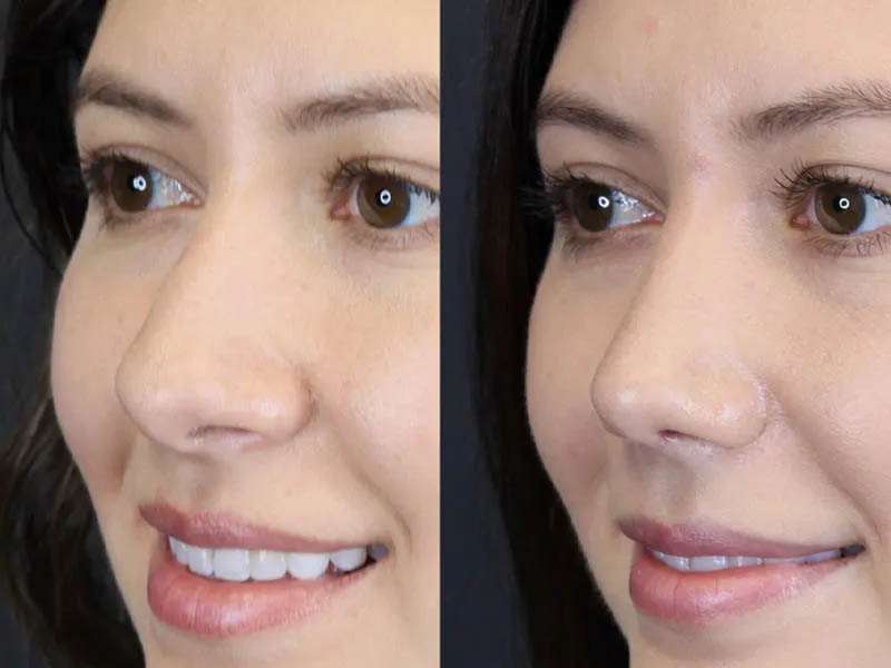 Rhinoplasty case #7324