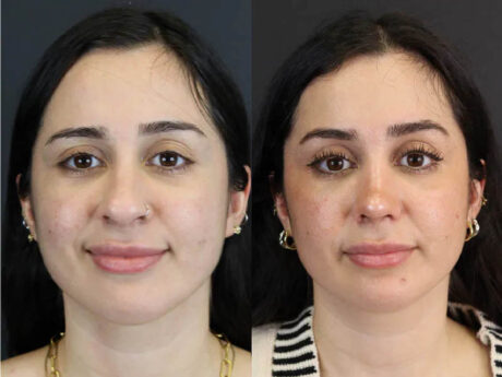 Rhinoplasty case #7347