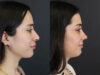 Rhinoplasty case #7347 slider thumbnail