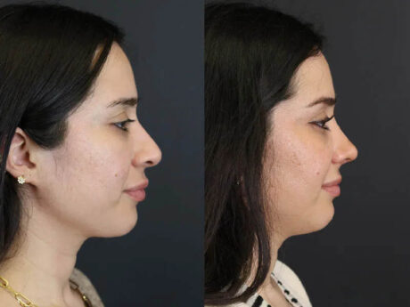 Rhinoplasty case #7347