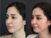 Rhinoplasty case #7347 slider thumbnail