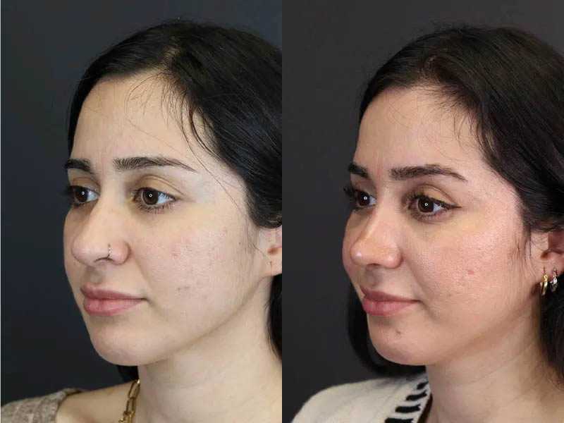 Rhinoplasty case #7347