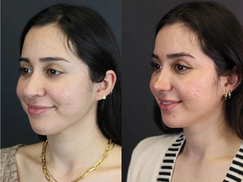 Rhinoplasty case #7347
