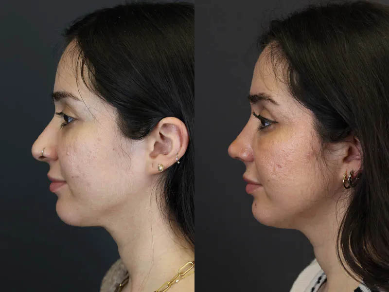 Rhinoplasty case #7347