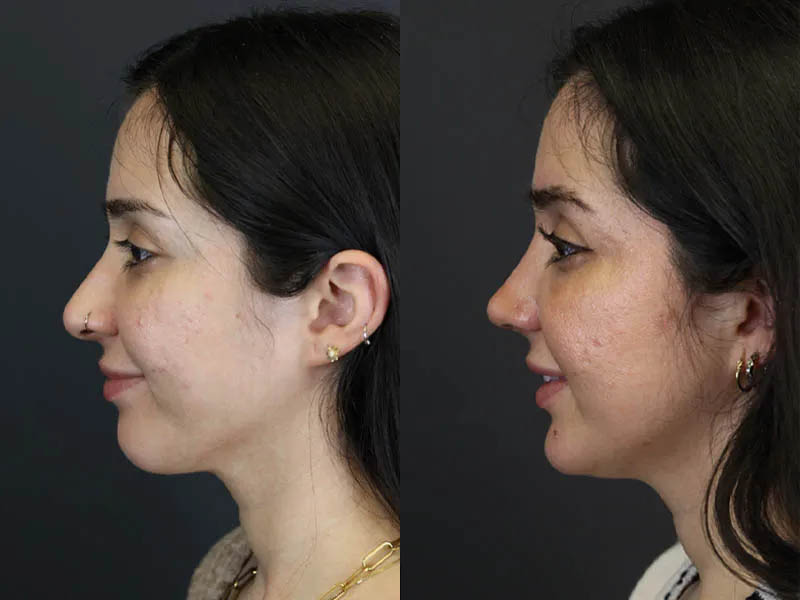 Rhinoplasty case #7347
