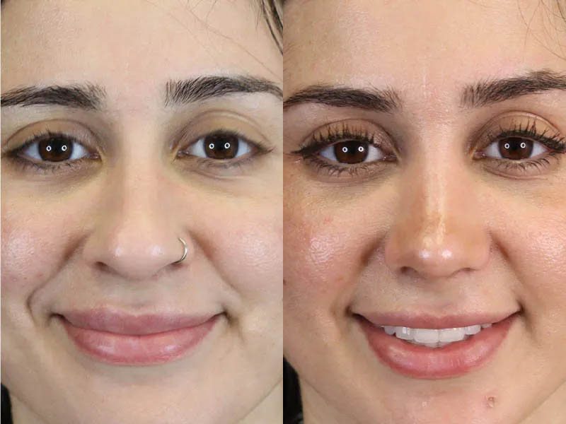 Rhinoplasty case #7347