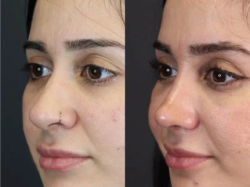 Rhinoplasty case #7347