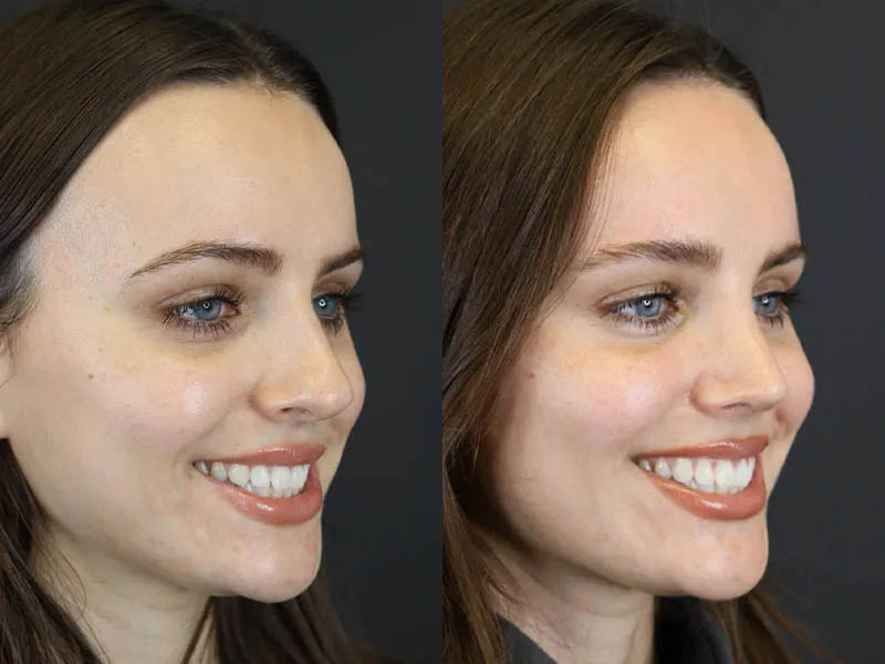 Rhinoplasty case #7390