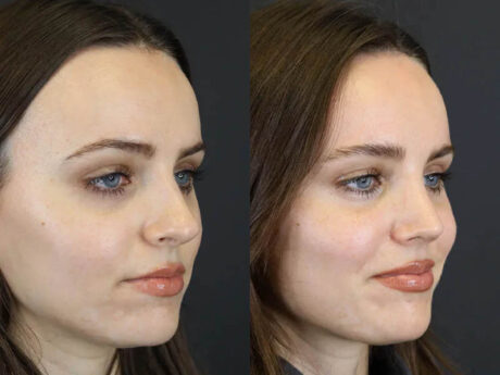 Rhinoplasty case #7390