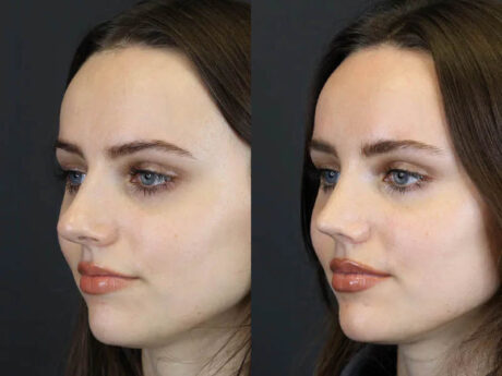 Rhinoplasty case #7390