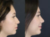 Rhinoplasty case #7324 slider thumbnail