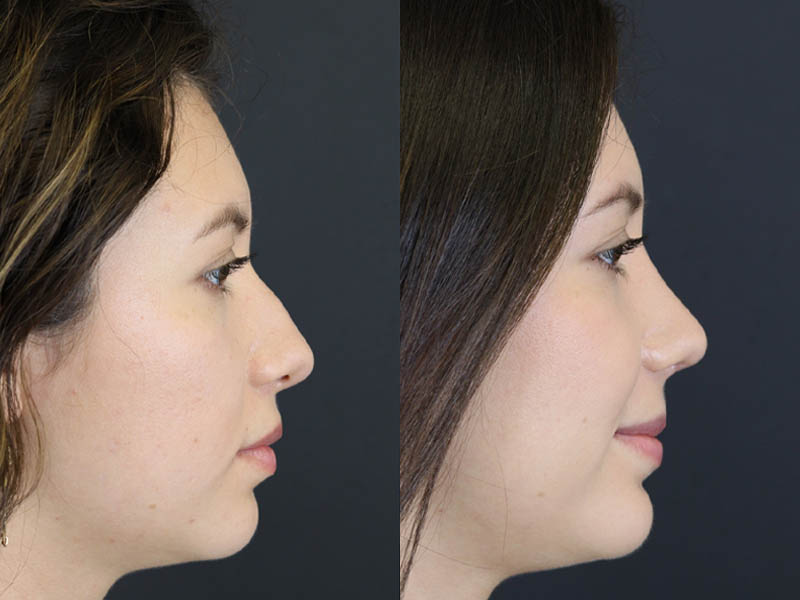 Rhinoplasty case #7324