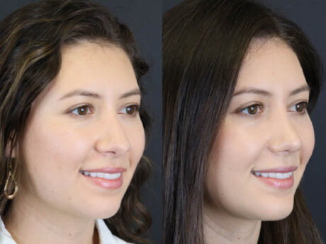 Rhinoplasty case #7324