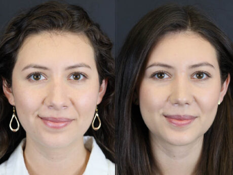 Rhinoplasty case #7324