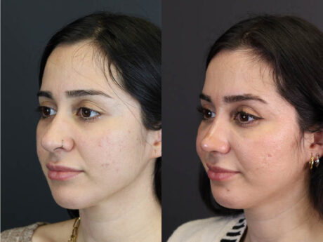 Rhinoplasty case #7347