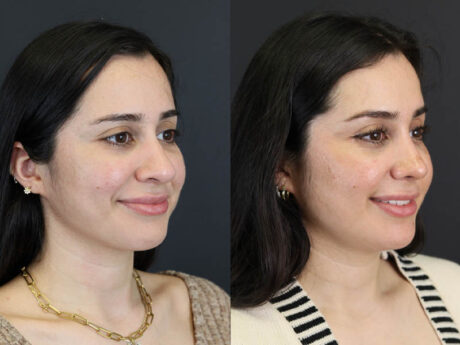 Rhinoplasty case #7347