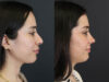 Rhinoplasty case #7347 slider thumbnail