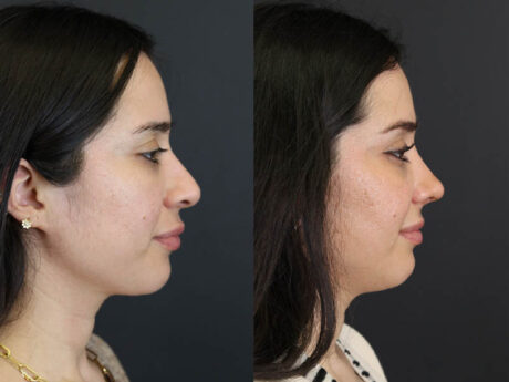 Rhinoplasty case #7347