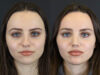Rhinoplasty case #7390 slider thumbnail