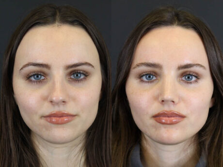 Rhinoplasty case #7390