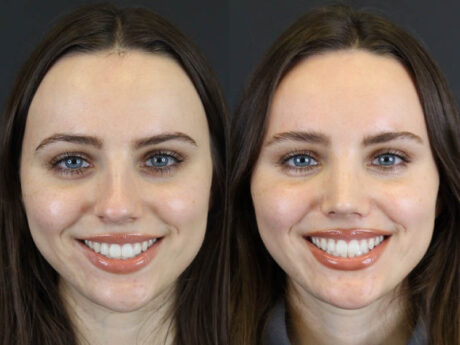 Rhinoplasty case #7390