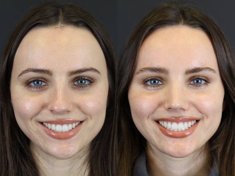 Rhinoplasty case #7390