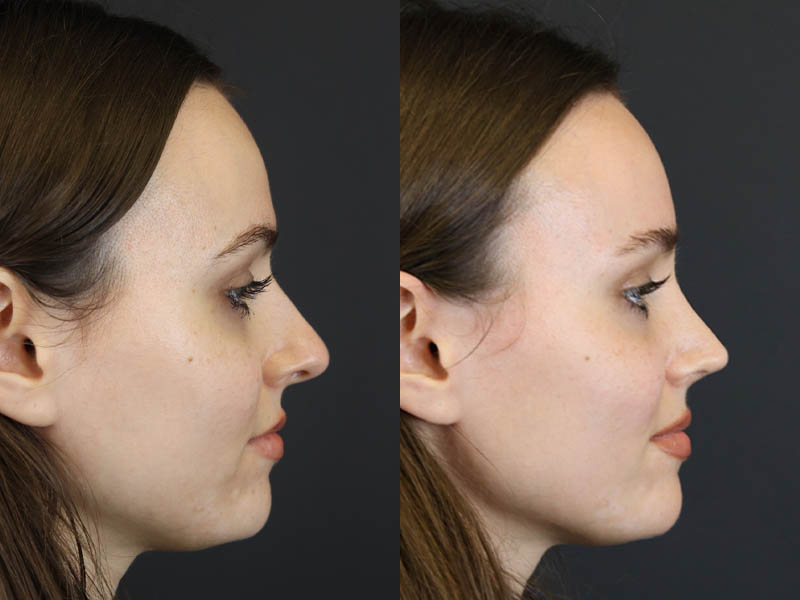 Rhinoplasty case #7390