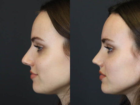 Rhinoplasty case #7390