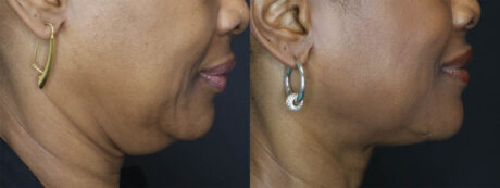 Fat Grafting case #7587