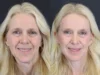 Brow Lift case #7418 slider thumbnail