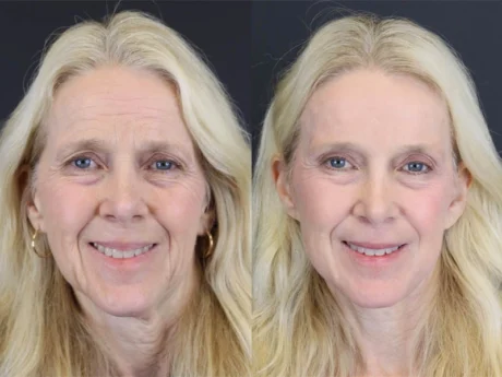 Brow Lift case #7418
