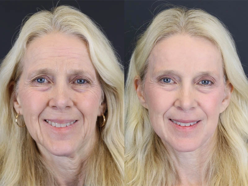 Brow Lift case #7418