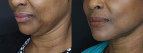 Fat Grafting case #7587