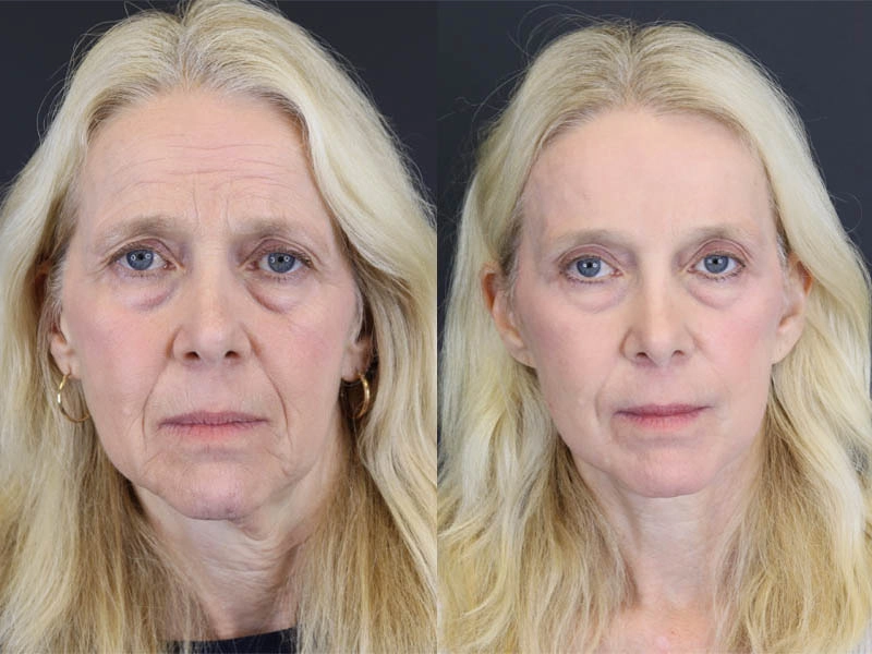 Brow Lift case #7418