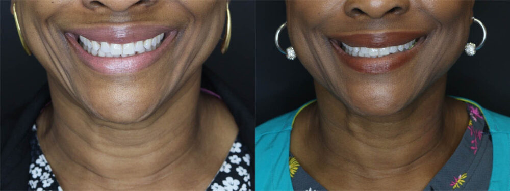 Fat Grafting case #7587